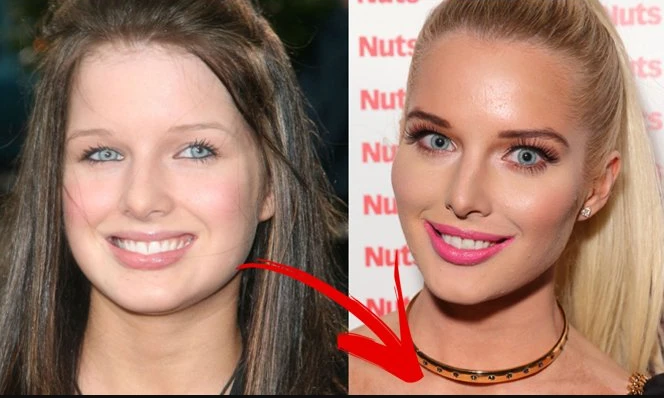 Helen Flanagan Plastic Surgery is a popular actress and model who is best known for playing Rosie Webster on the long-running soap opera Coronation Street. She is also a regular on various magazines and reality shows, and was voted the sexiest woman in the UK by FHM in 2013. But over the years, Helen Flanagan’s appearance has changed dramatically, sparking rumors of plastic surgery. What has the star done to her face and body? And why did she decide to go under the knife? In this article, we will reveal the truth about Helen Flanagan’s plastic surgery, including her before and after photos, her reasons, and her results.